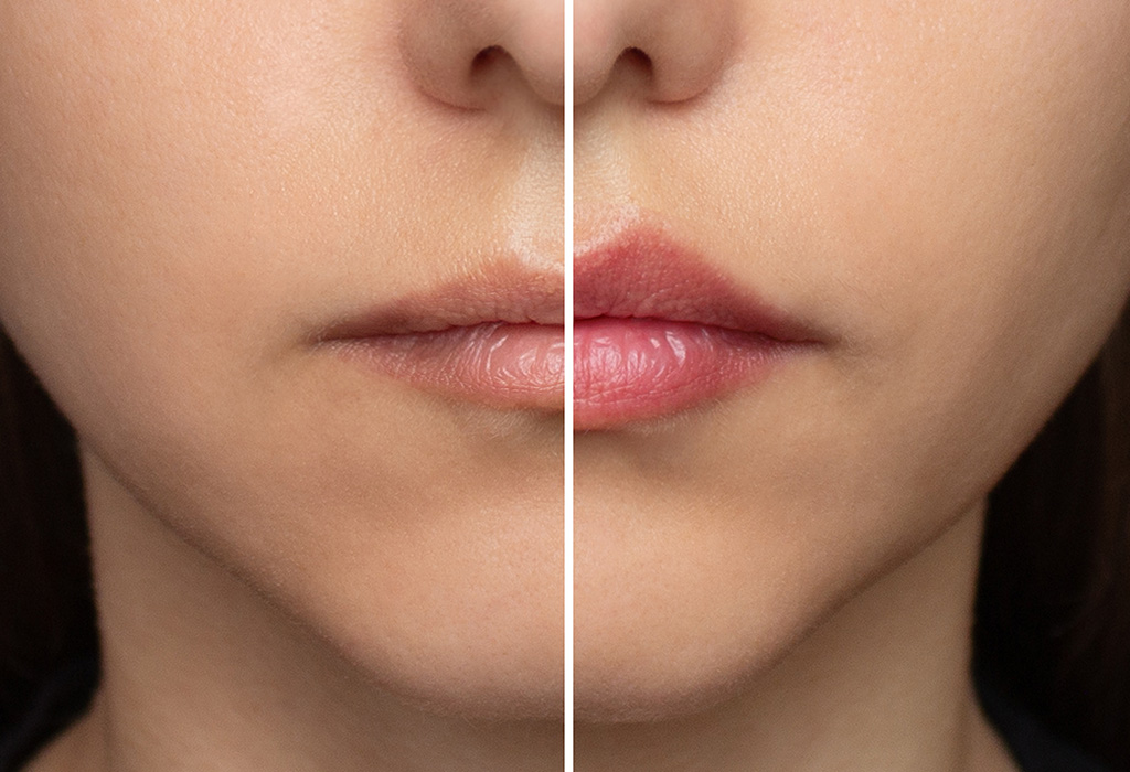 Juvederm Dermal Filler Near Florence + Hartsville SC Juvederm Dermal Filler Near Florence + Hartsville SC