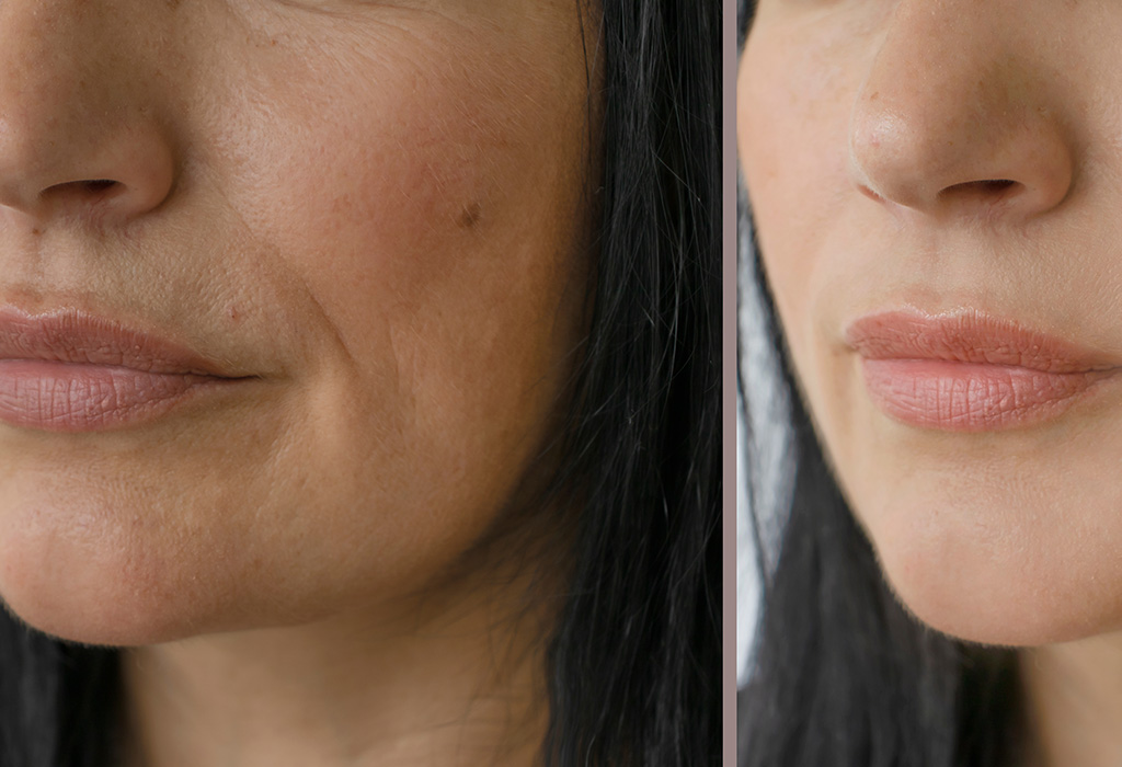 Kybella Near Florence + Hartsville SC Kybella Near Florence + Hartsville SC