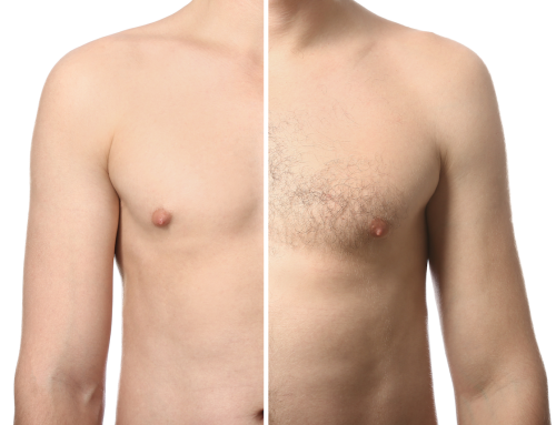 Laser Hair Removal for Men: An Overview