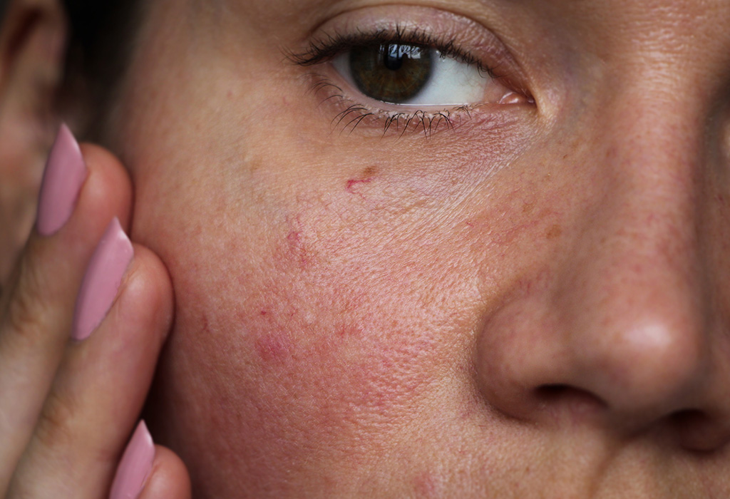 Fotona Rosacea Therapy Near Florence + Hartsville SC Fotona Rosacea Therapy Near Florence + Hartsville SC
