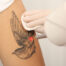 Laser Tattoo Removal in Florence SC