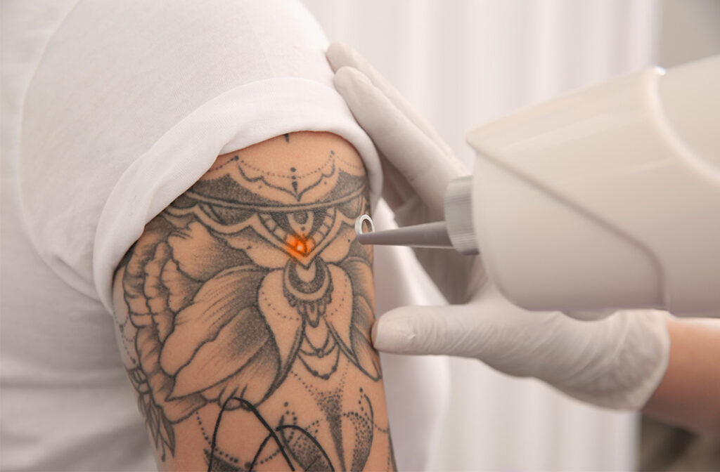 Laser Tattoo Removal - What to Expect When Starting Treatment?