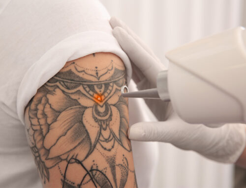 Laser Tattoo Removal – What to Expect When Starting Treatment?