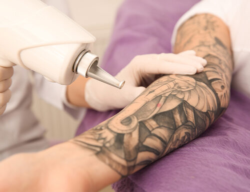 Laser Tattoo Removal Near Florence, SC