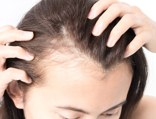Hair Restoration Near Florence, SC