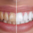 Teeth Whitening