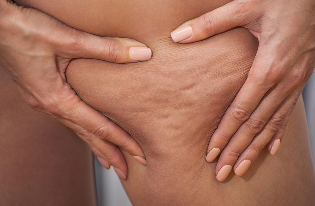 Comprehensive Cellulite Solutions