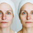 IPL (Intense Pulsed Light)